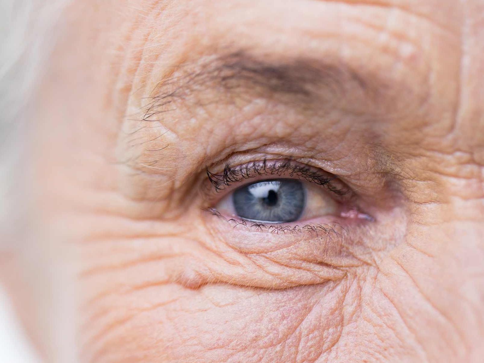 Bildet viser et nærbilde av et usunt øye, som illustrerer potensielle okulære adnexa-farer. 