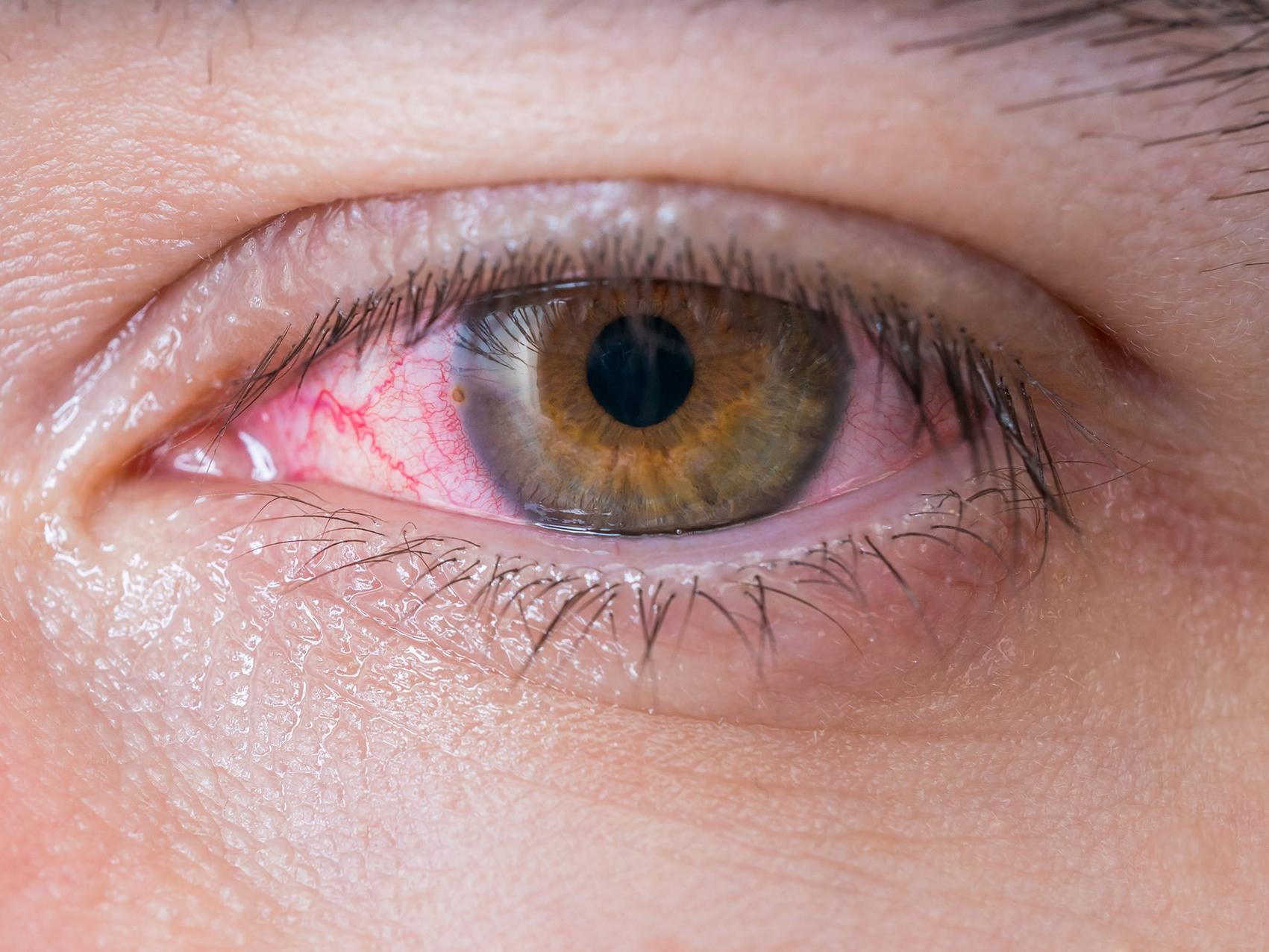 Bildet viser et nærbilde av et usunt øye, som illustrerer hvordan potensielle farer for øynene kan se ut. 