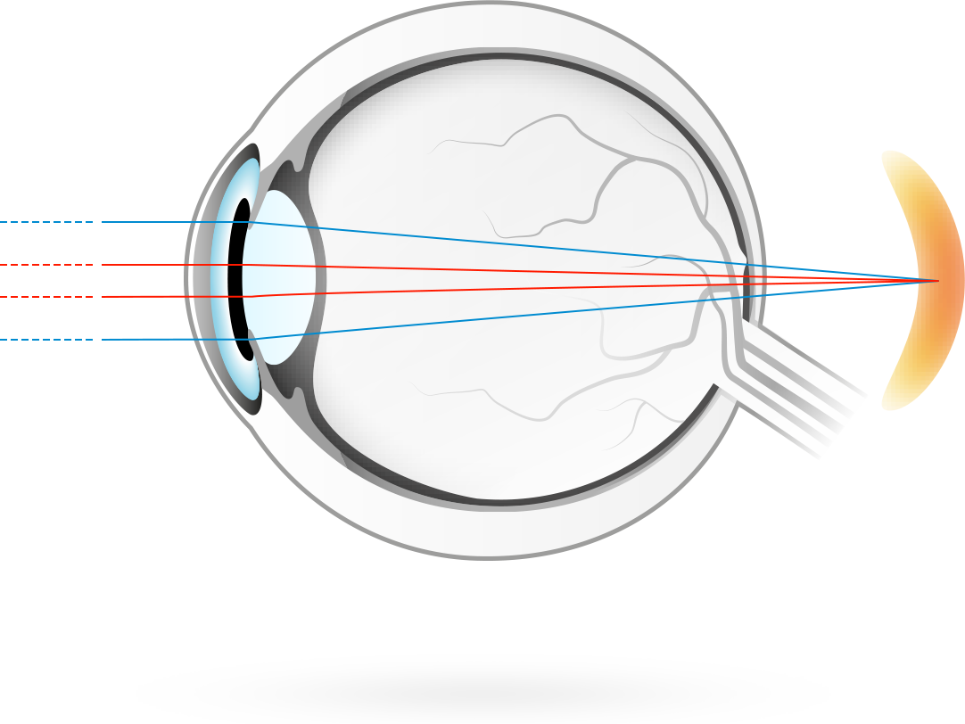 Langsynthet – tilstand hvor synsinntrykk blir fokusert bak netthinnen, noe som gjør det vanskeligere for øynene å fokusere på nære gjenstander