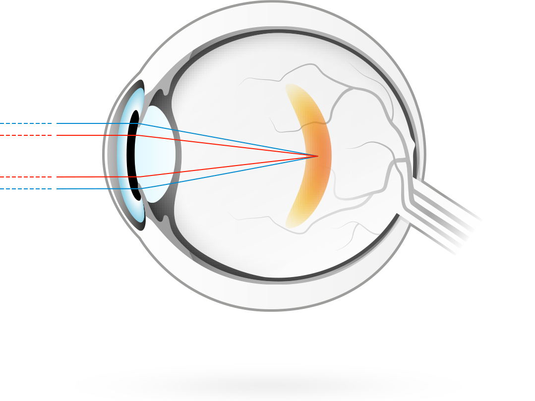 Nærsynthet – tilstand hvor synsinntrykk blir fokusert inne i netthinnens front, noe som forårsaker uklart avstandssyn