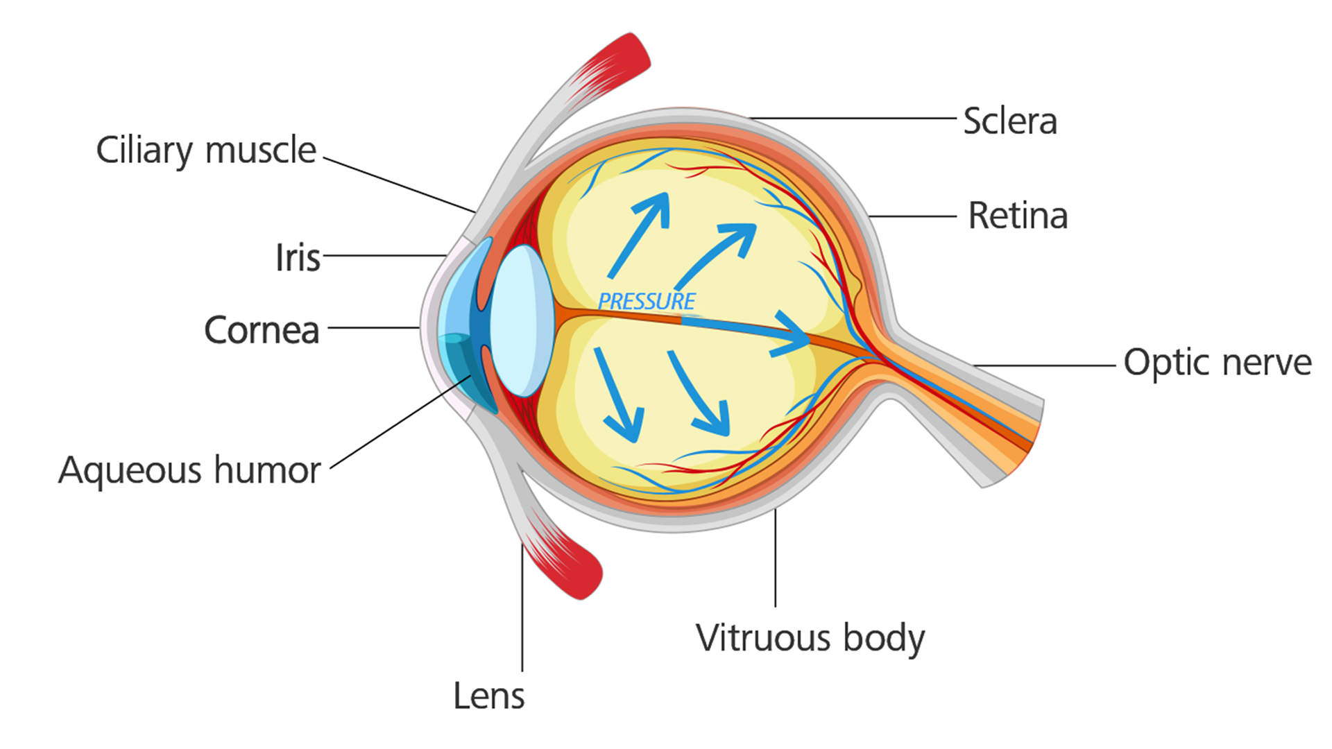 Øye med glaukom: Øyetrykket bygges opp og gjør skader på den optiske nerven.