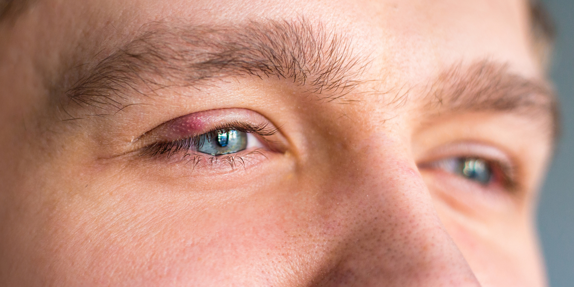 Betennelse i øyelokk-kantene (blefaritt)
