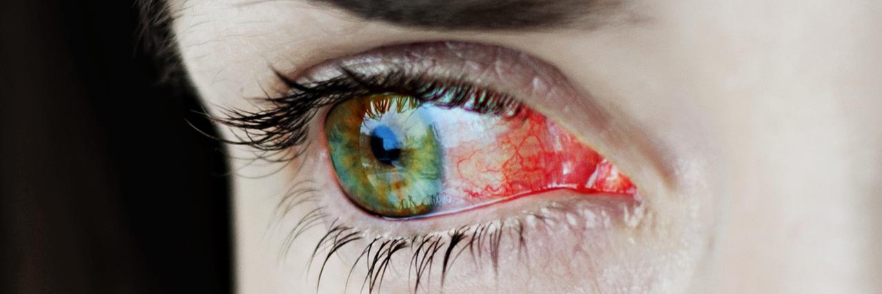 Nærbilde av irriterte eller infiserte røde blodskutte øyne - uveitt