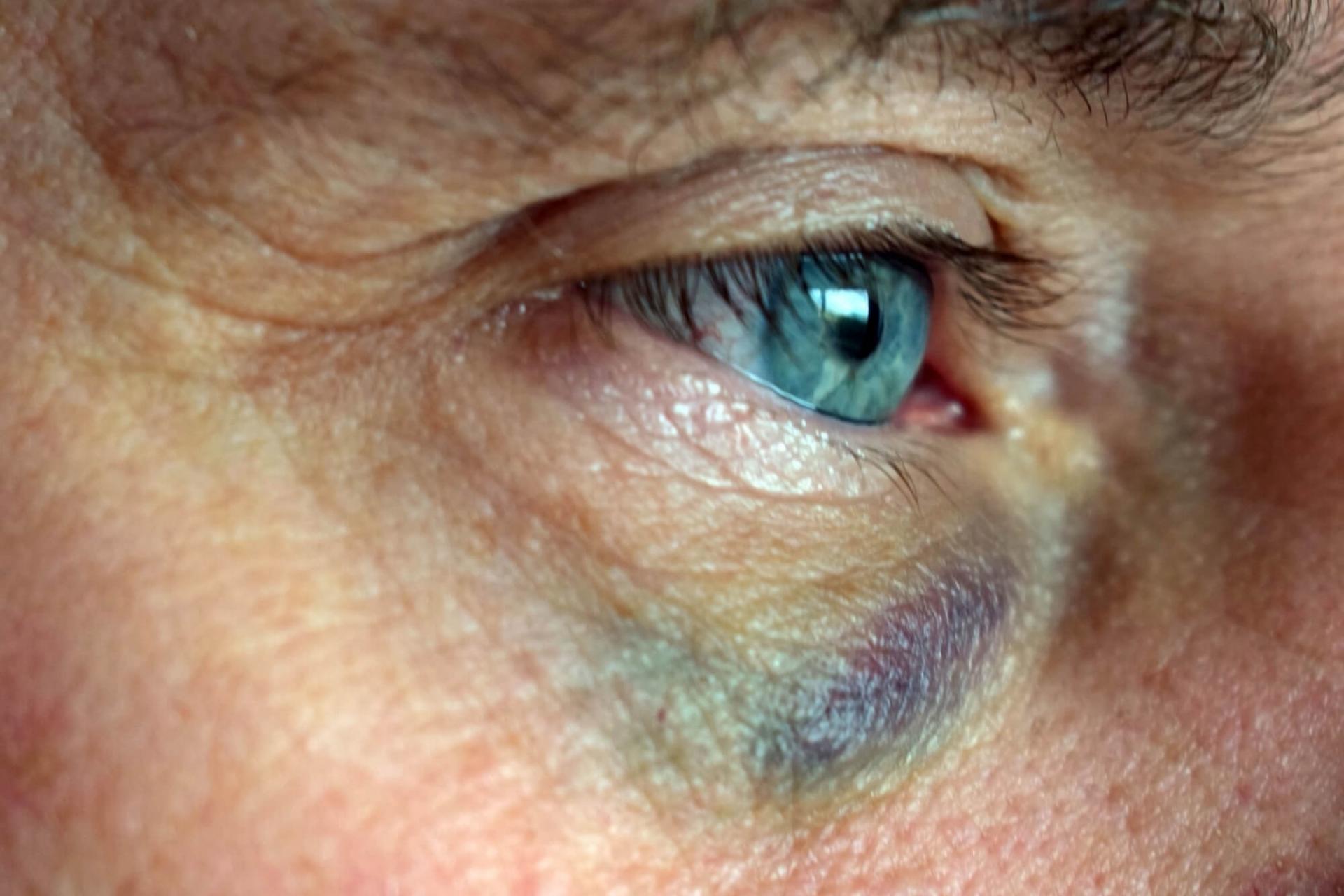På grunn av stump vold kan blodårene i øyet sprikke og den hvite delen av øyet (sclera) vil fremstå som blodskutt.