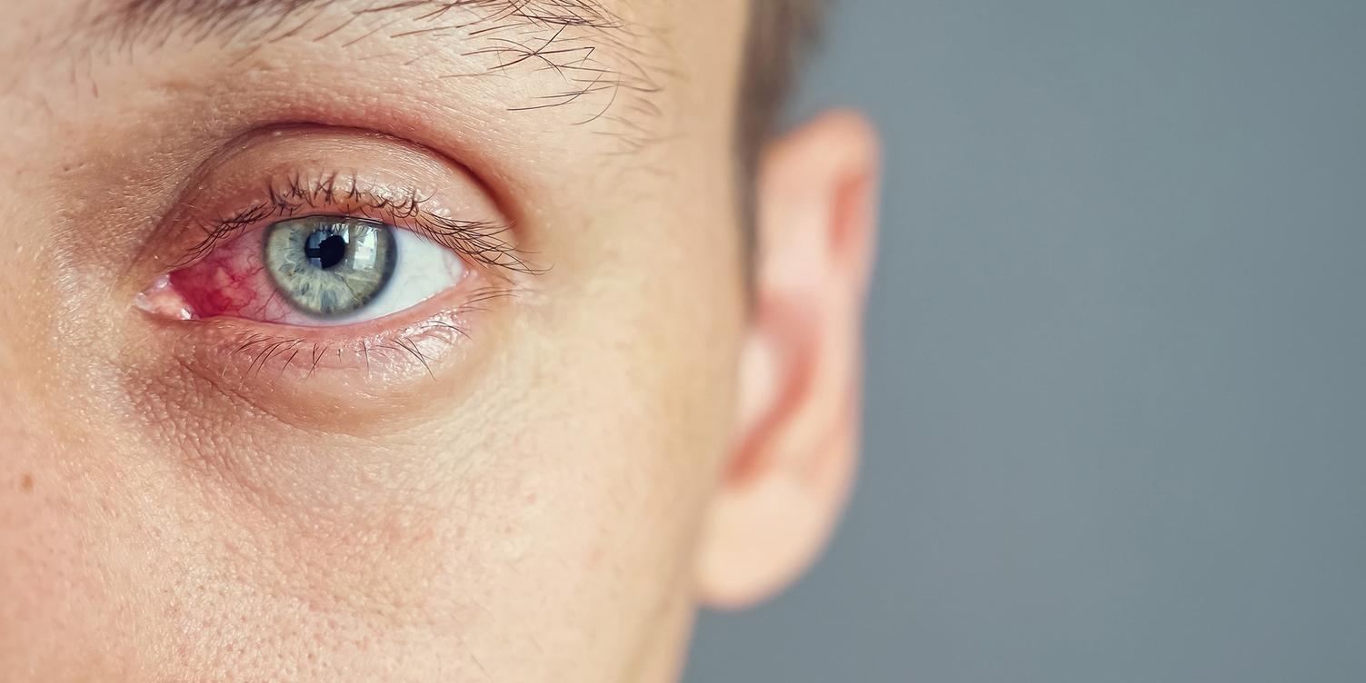 Nærbilde av det røde øyet til en mann rammet av en infeksjon, øyekatarr