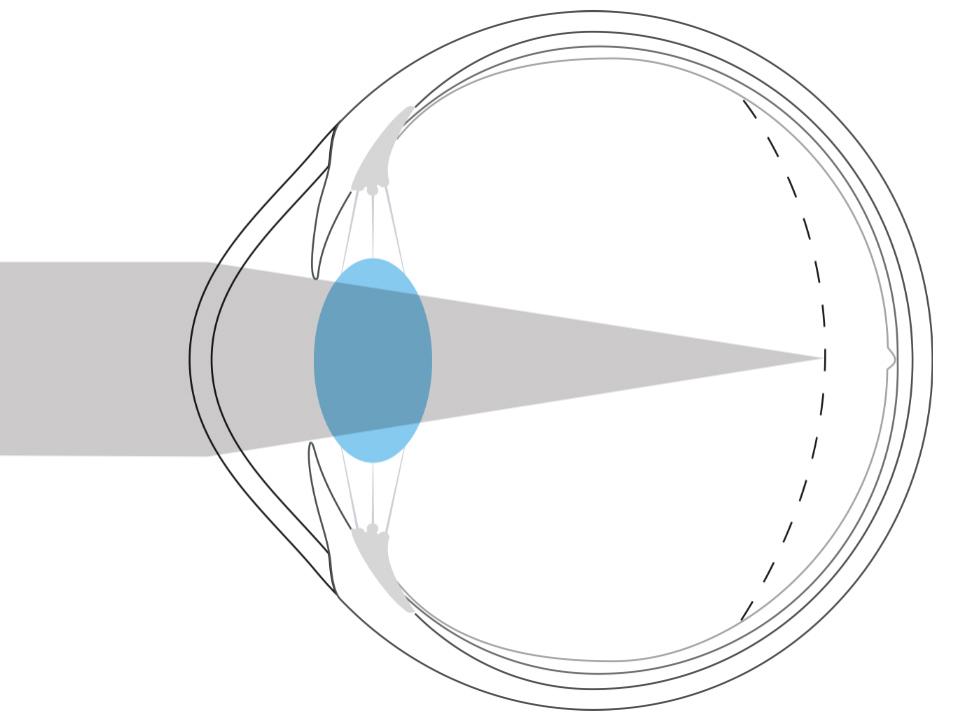 Illustrasjon av et nærsynt øye som viser at lyset er fokusert foran netthinnen.